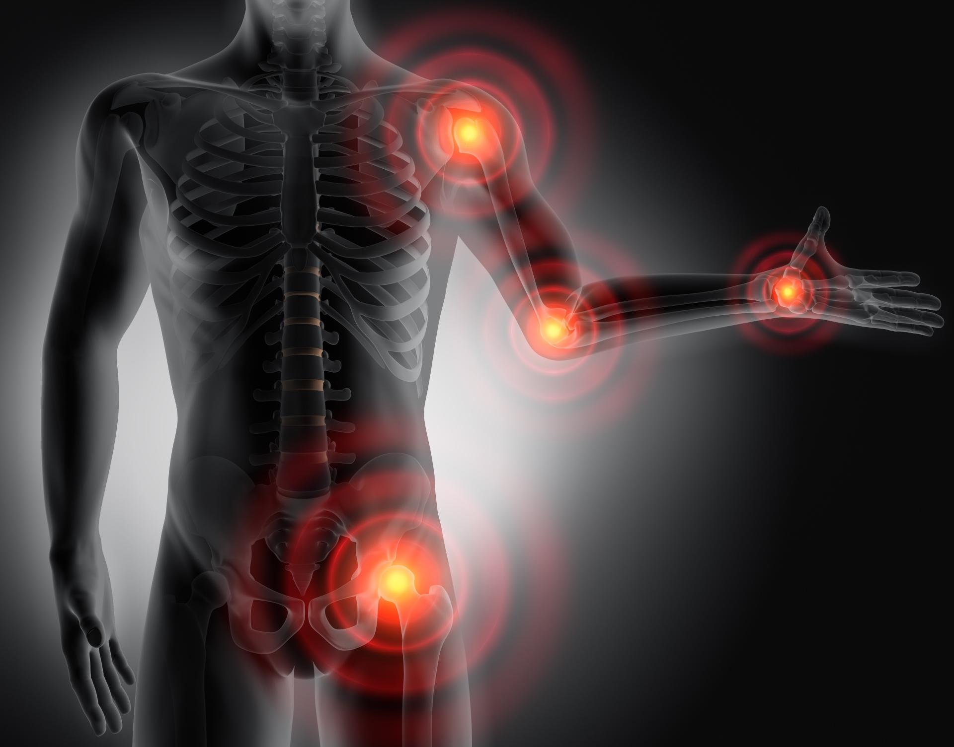 Rheumatoide Arthritis (RA) ist die häufigste chronisch entzündliche Gelenkerkrankung, die durch fortschreitende Gelenk- und Knochenzerstörung gekennzeichnet ist.